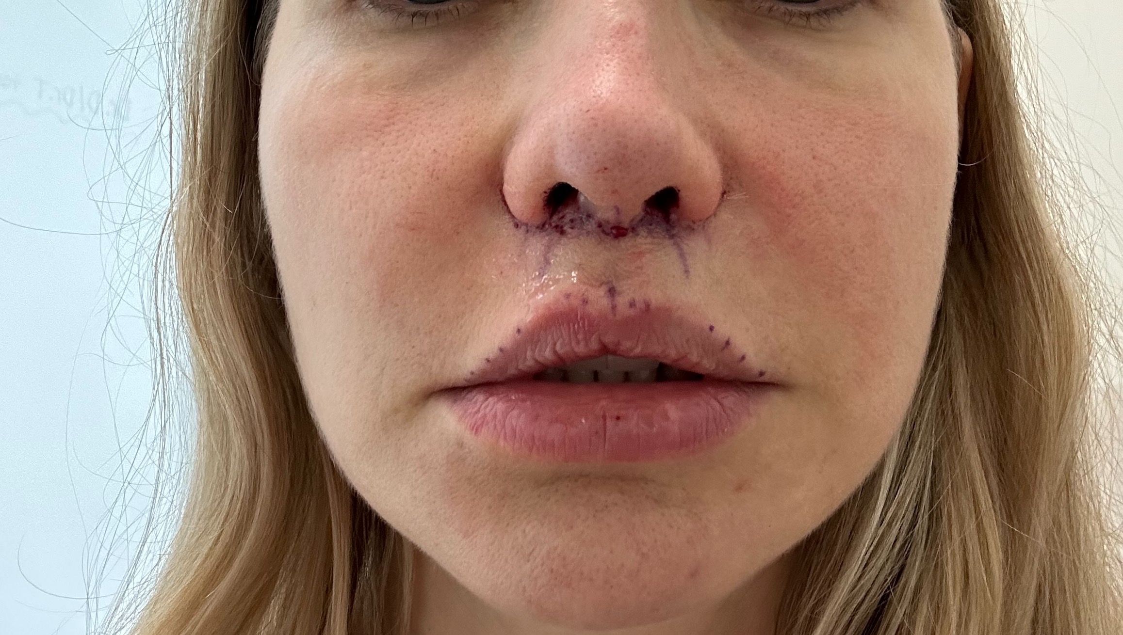 lip-lift-surgery.jpg