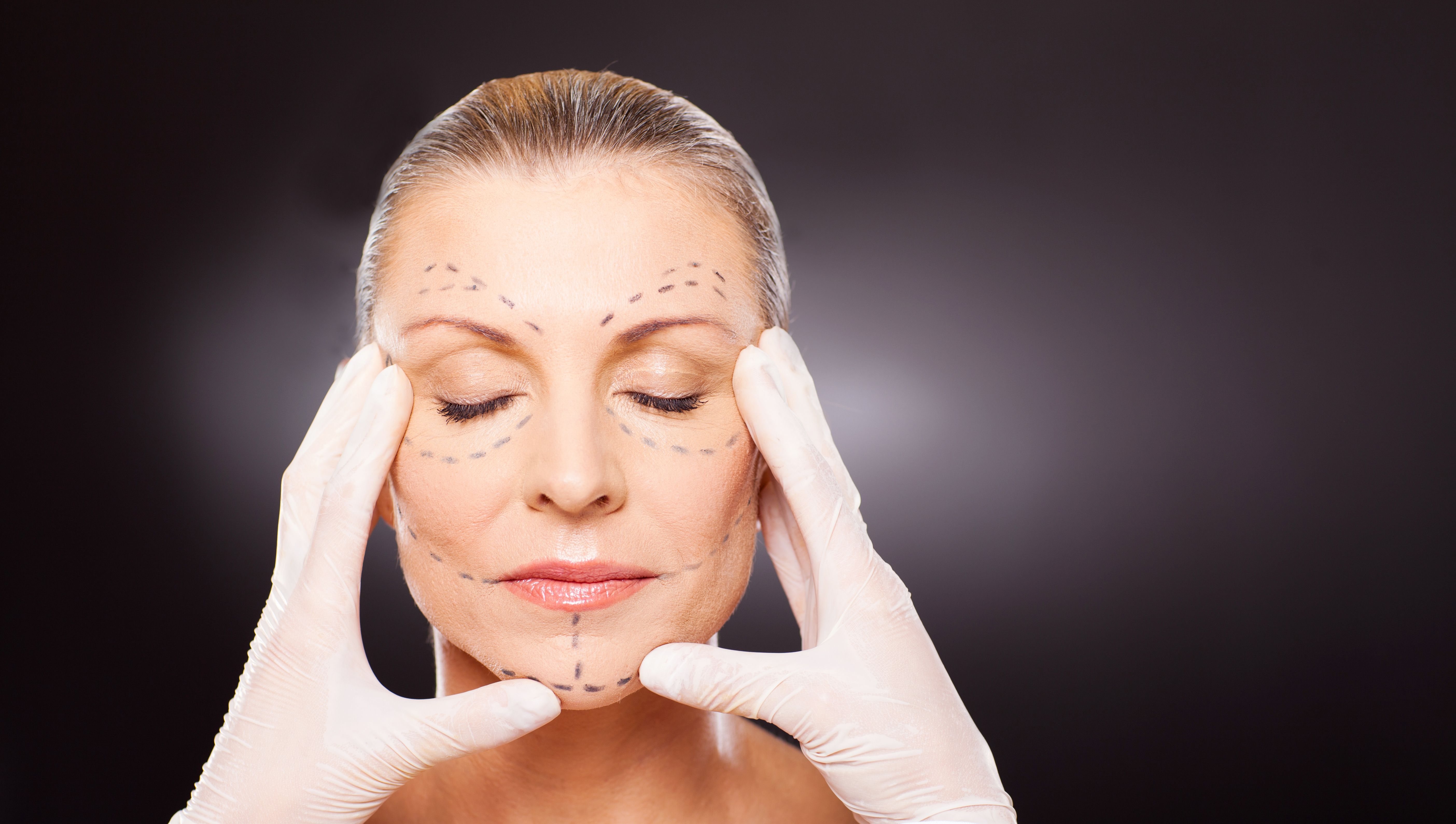 A close-up of a calm woman with her eyes closed and pre-operative surgical marking lines on her forehead and cheeks. A surgeon wearing white medical gloves is gently holding her face and jawline to evaluate her facial anatomy before a facelift procedure.