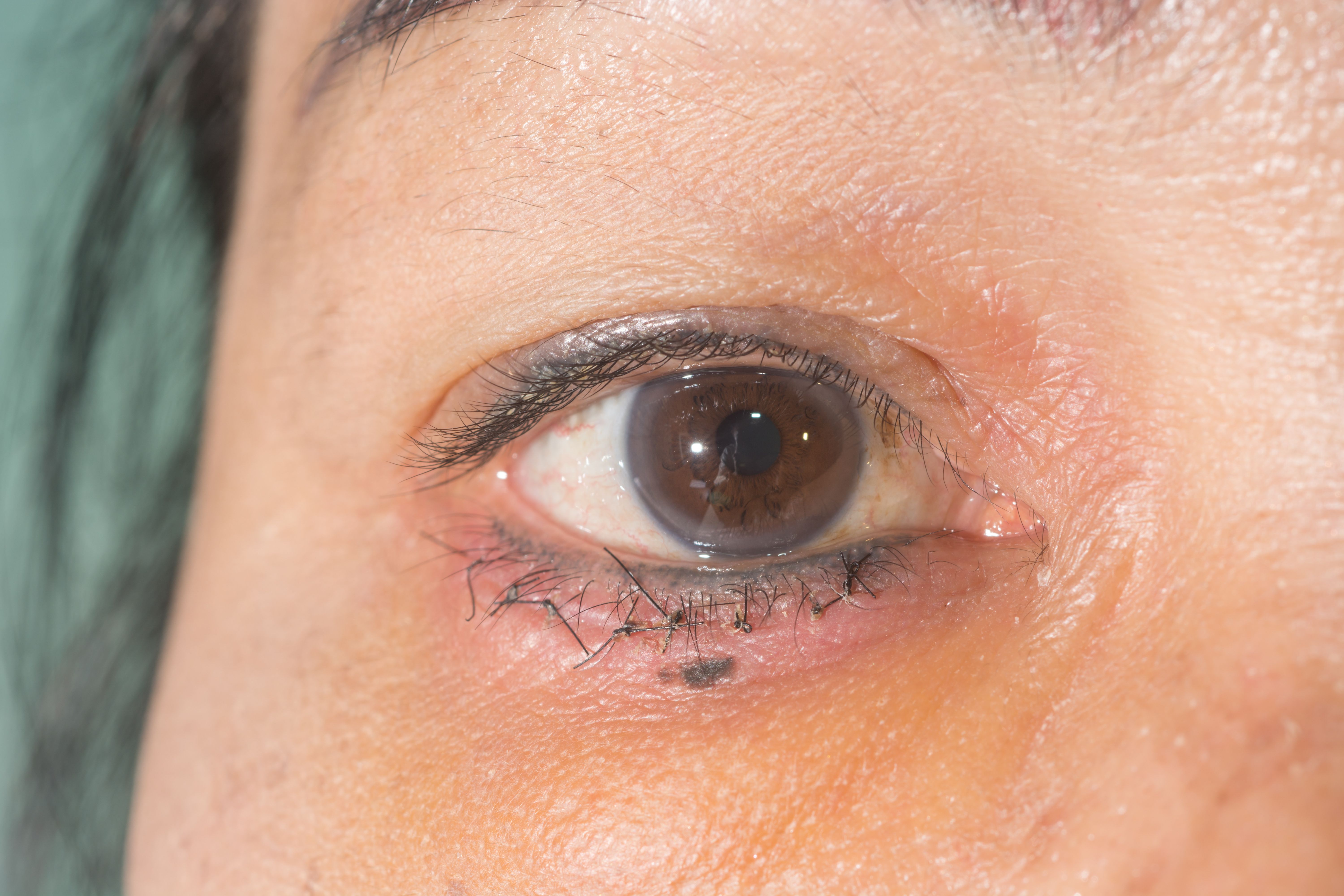 blepharoplasty:plasticsurgery.jpg