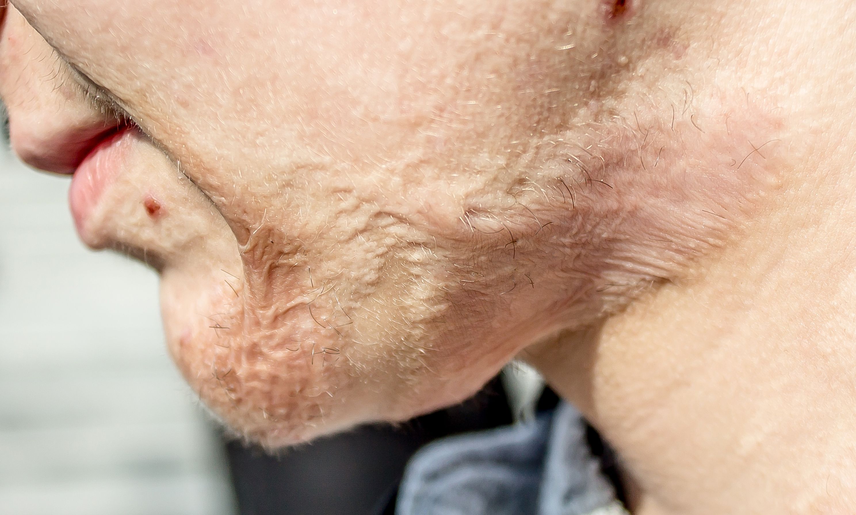 burn-skin-treatment-skin-plastic-surgeon.jpg
