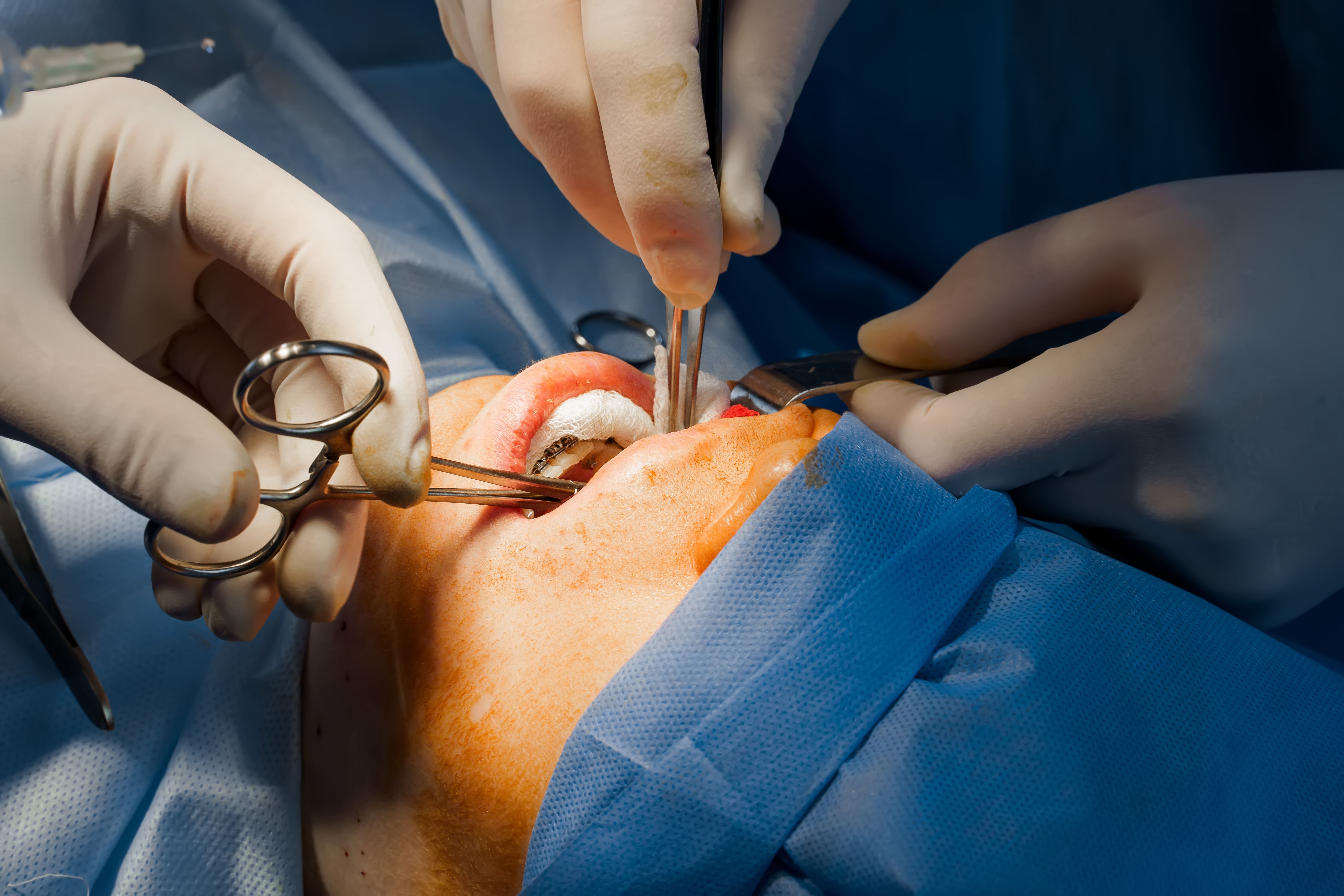 Buccal-fat-removal-surgery-Bishectomy-reviews-description.jpg