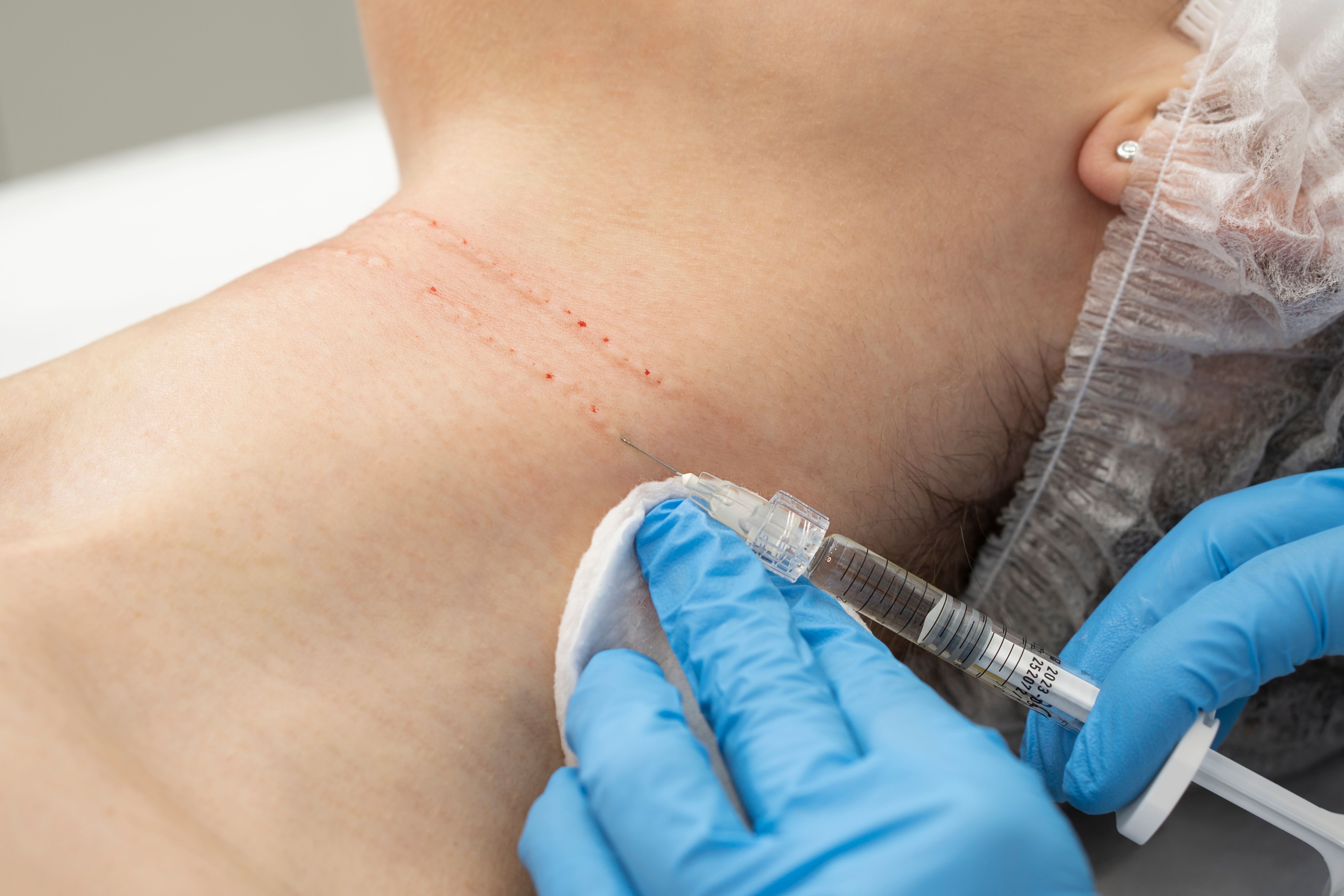 neckfillers:neckprocedure:reviews:therealpatients.jpg