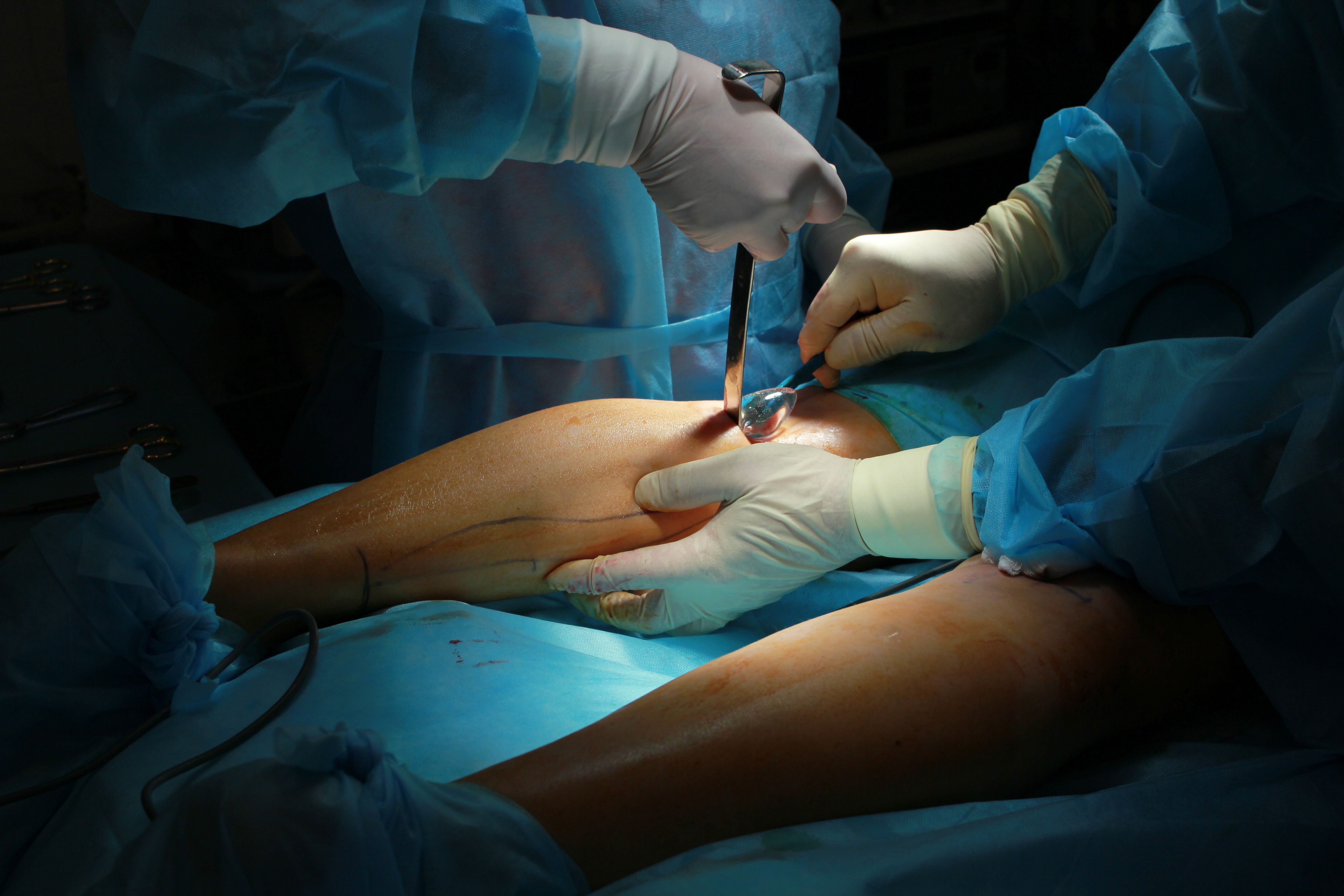 Calf-augmentation-surgery-calf-implants-reviews-description.jpg