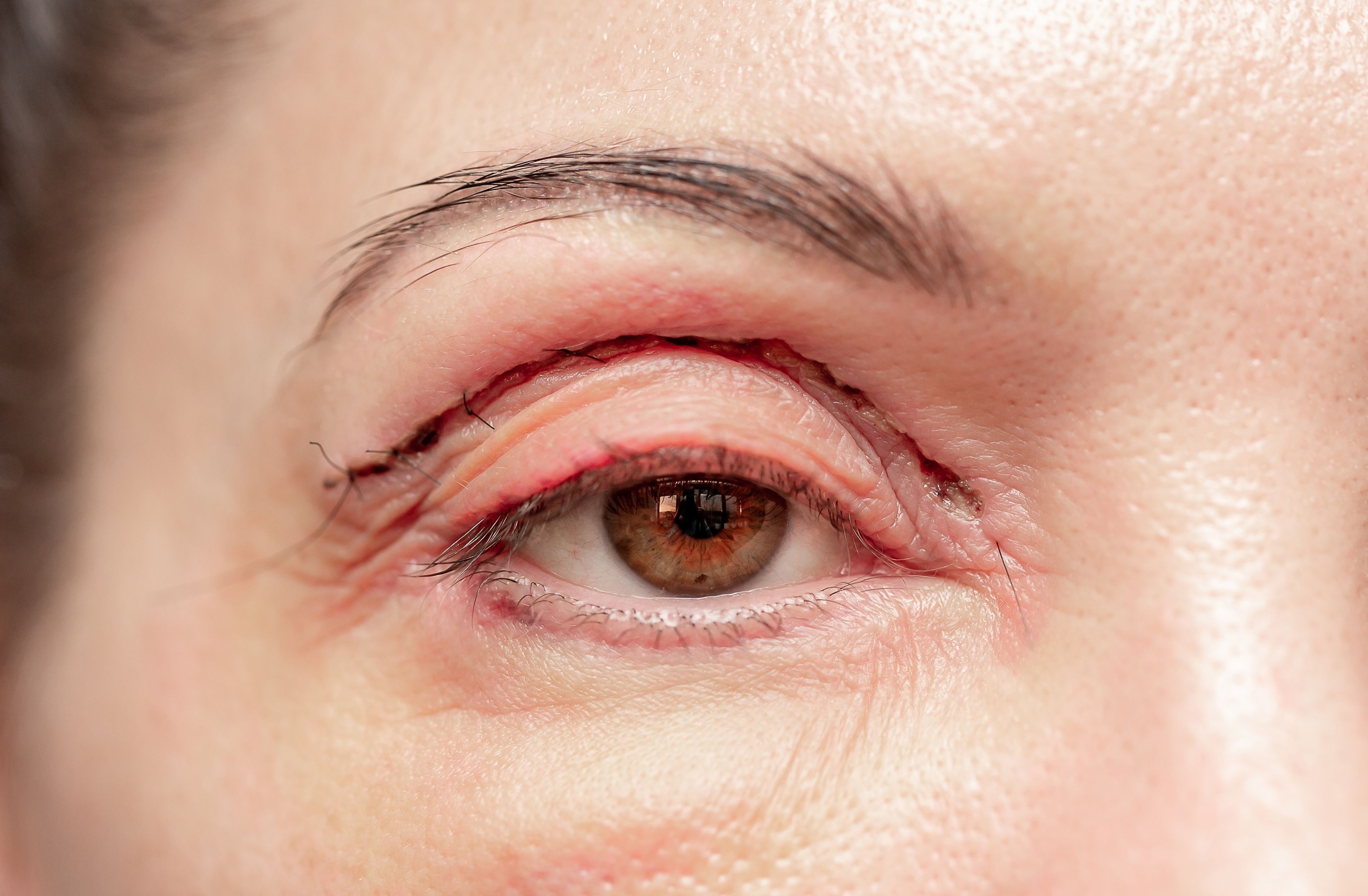 Eyelid-surgery-Blepharoplasty-description-reviews-sergeon.jpg