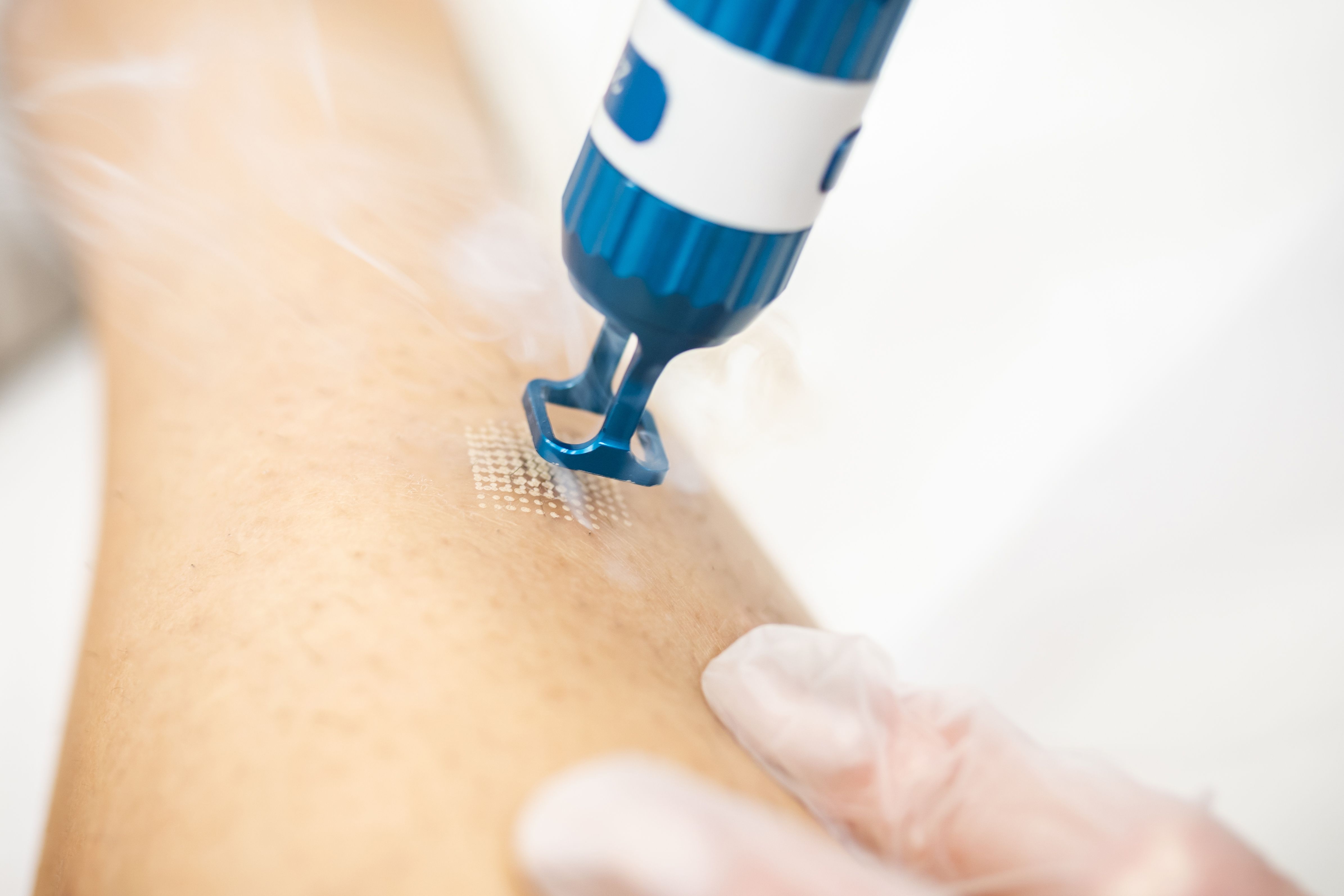 CO2-laser-procedure-body-description-reviews.jpg