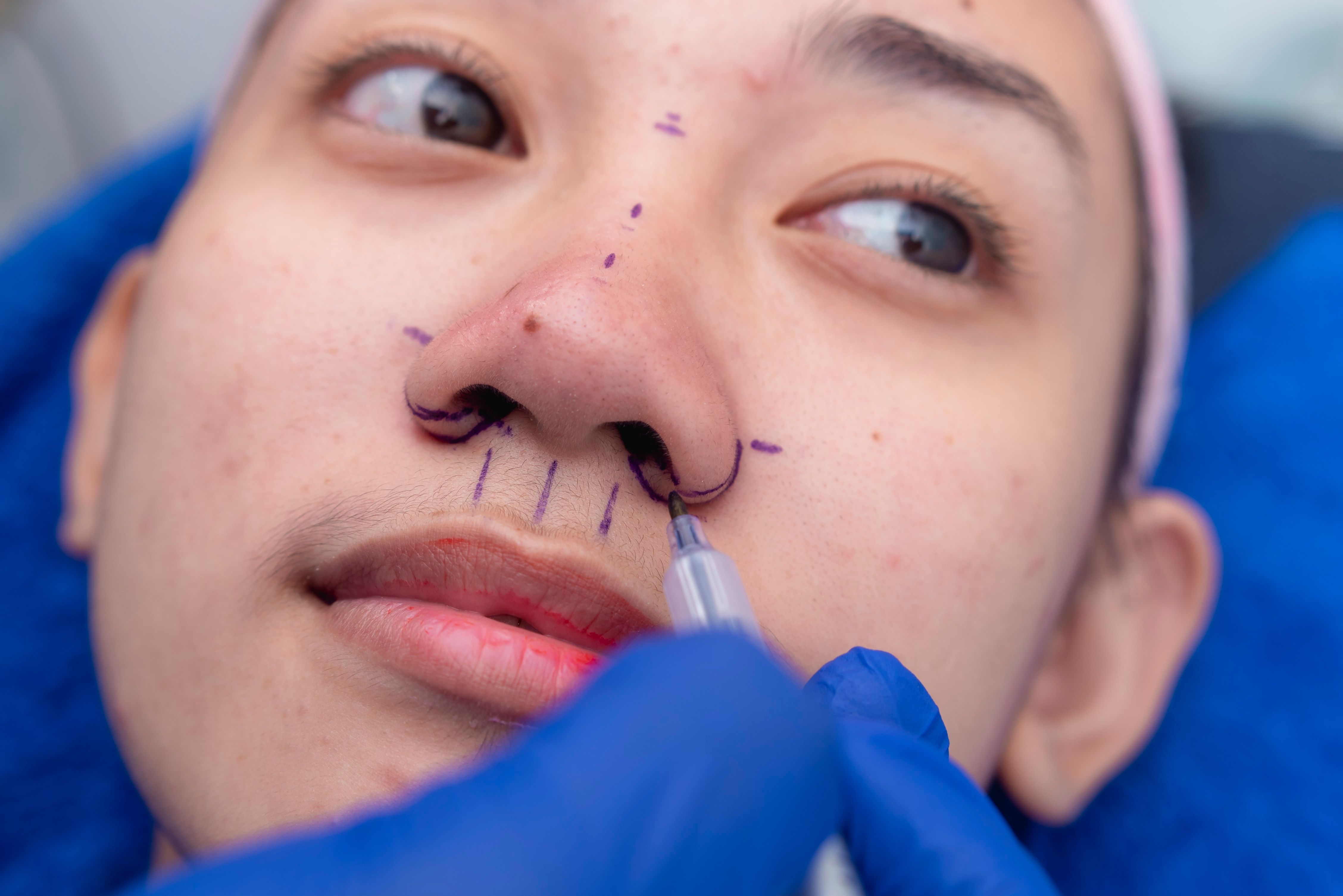 alarplasty-rhinoplasty-plastic-surgeon-ent-describtion-reviews.jpg