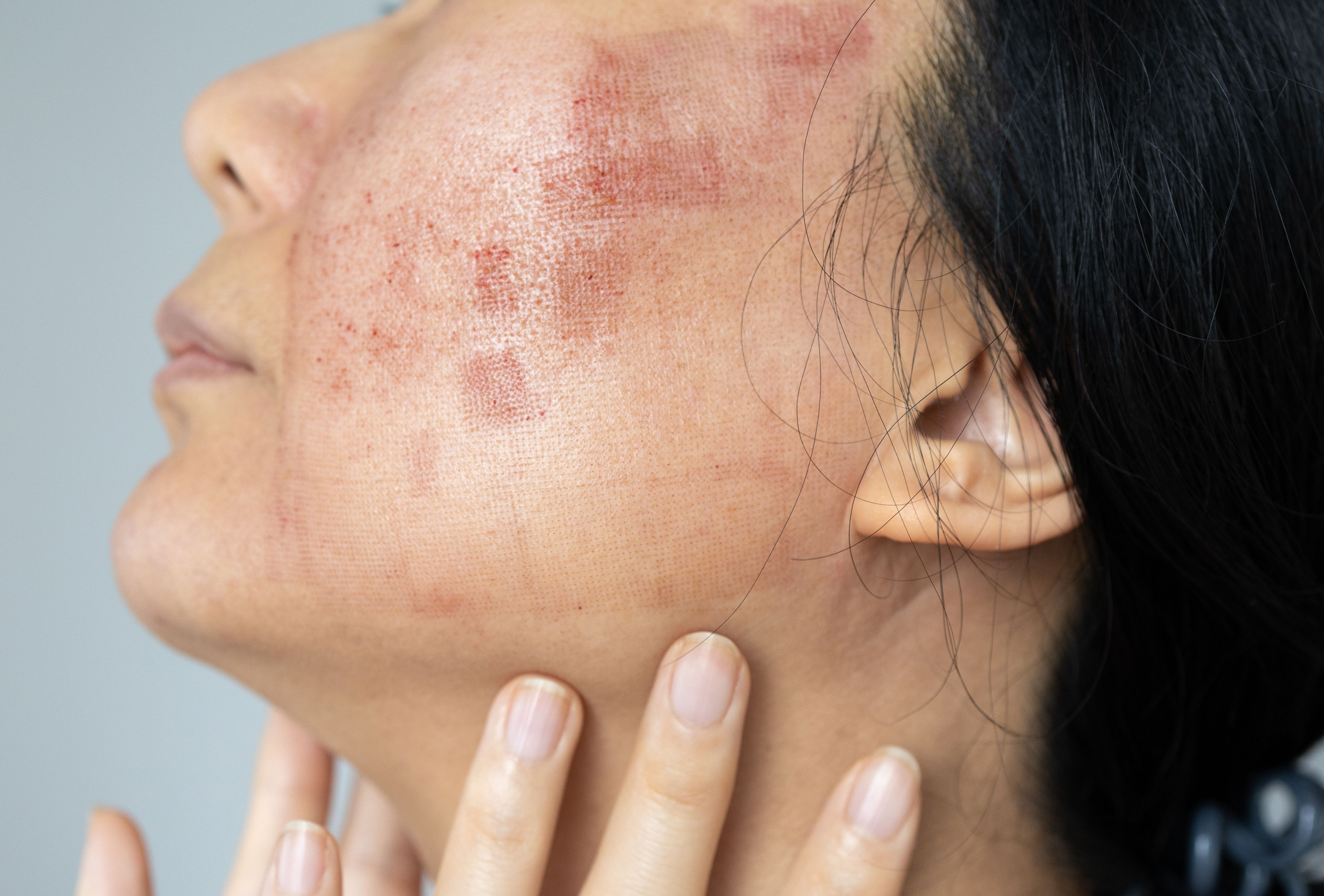 CO2-laser-procedure-face-description-reviews.jpg