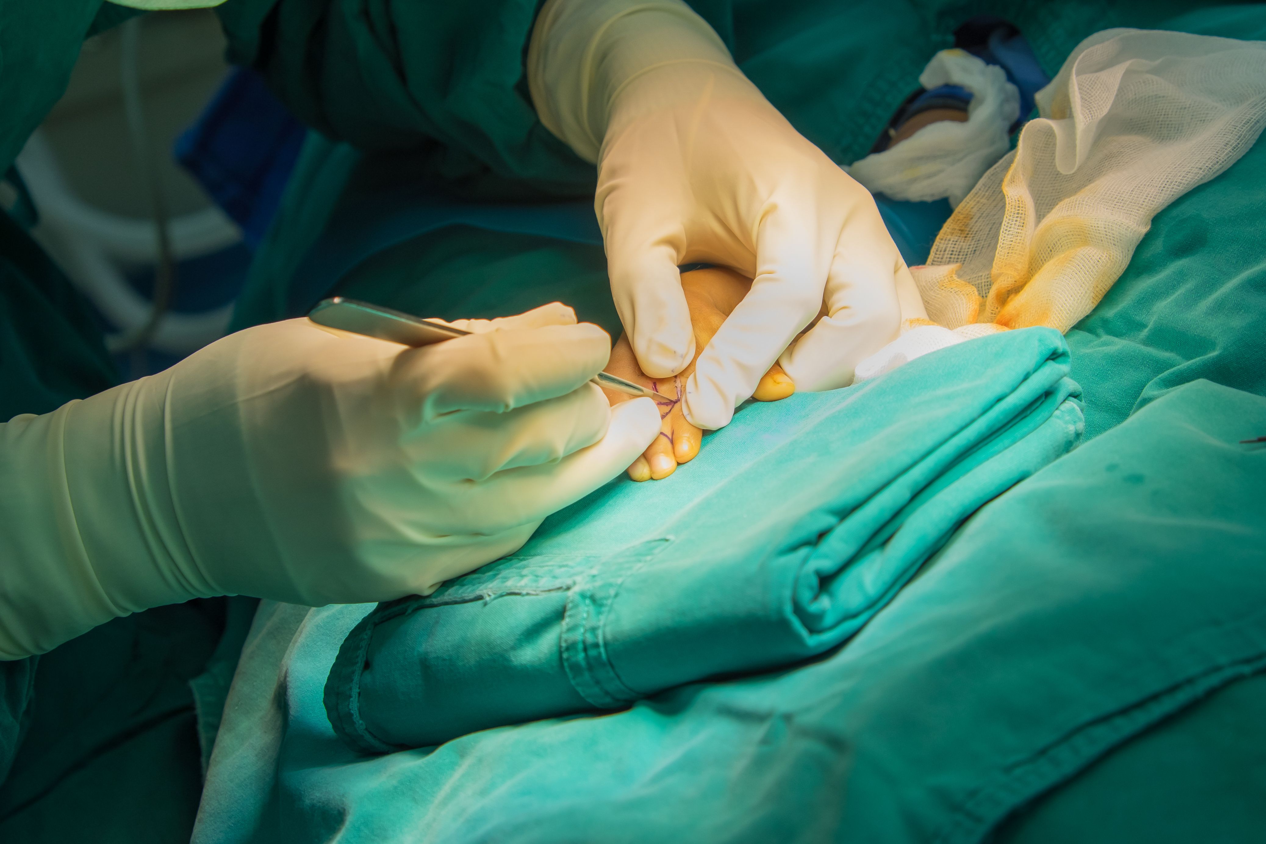 Adjacent-finger-Syndactyly-procedure.jpg