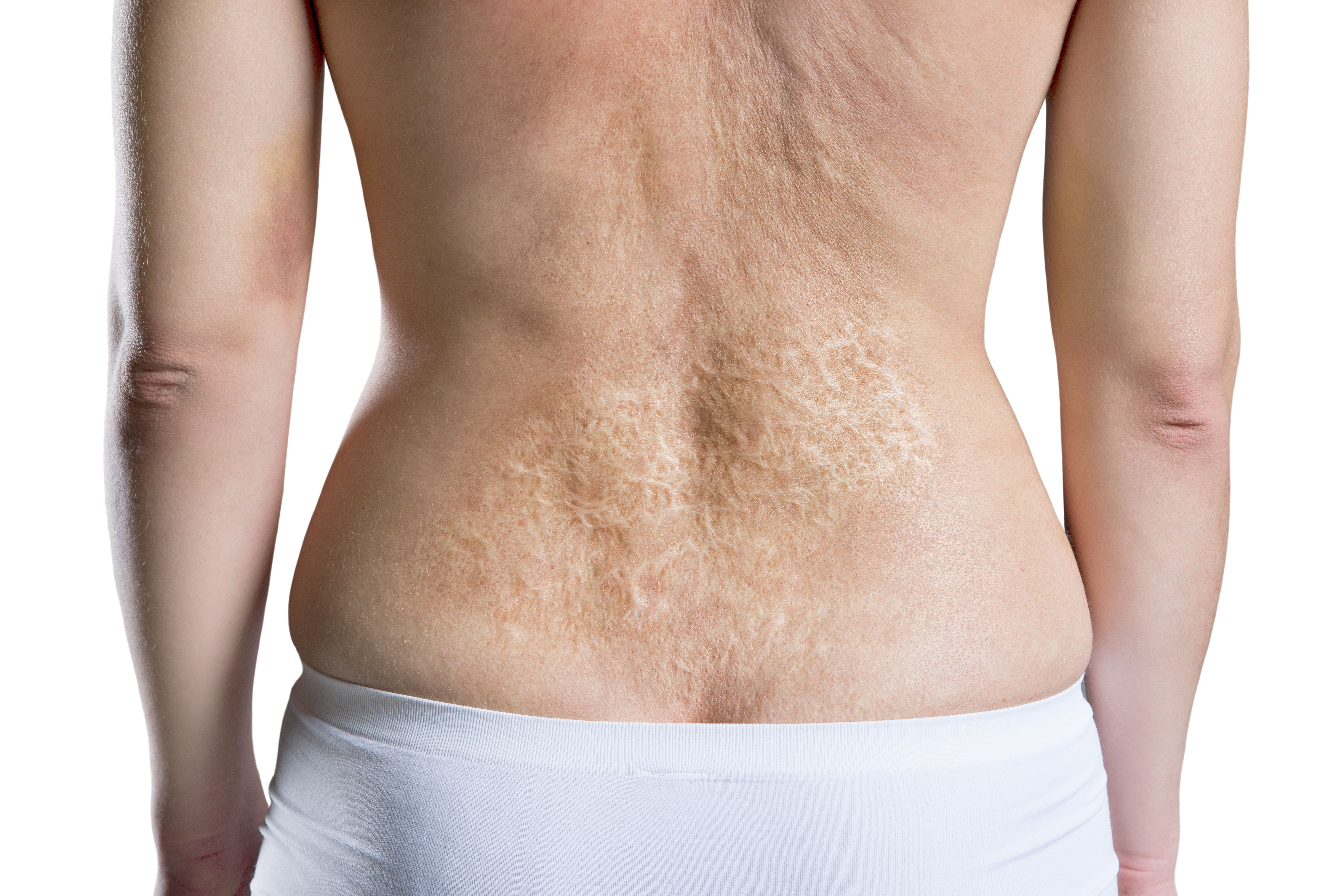 burn-skin-treatment-body.jpg