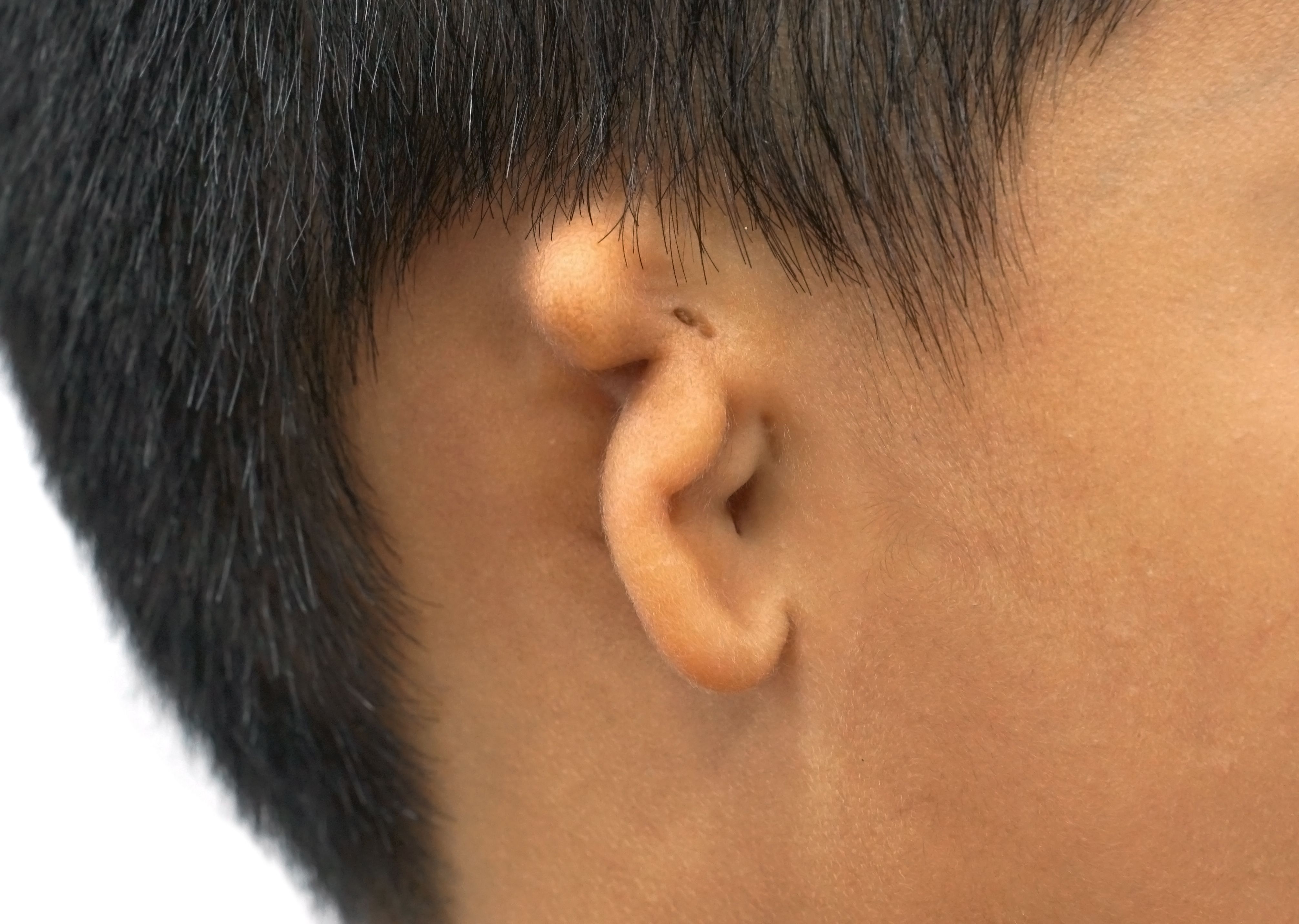 microtia-ears-surgery.jpg