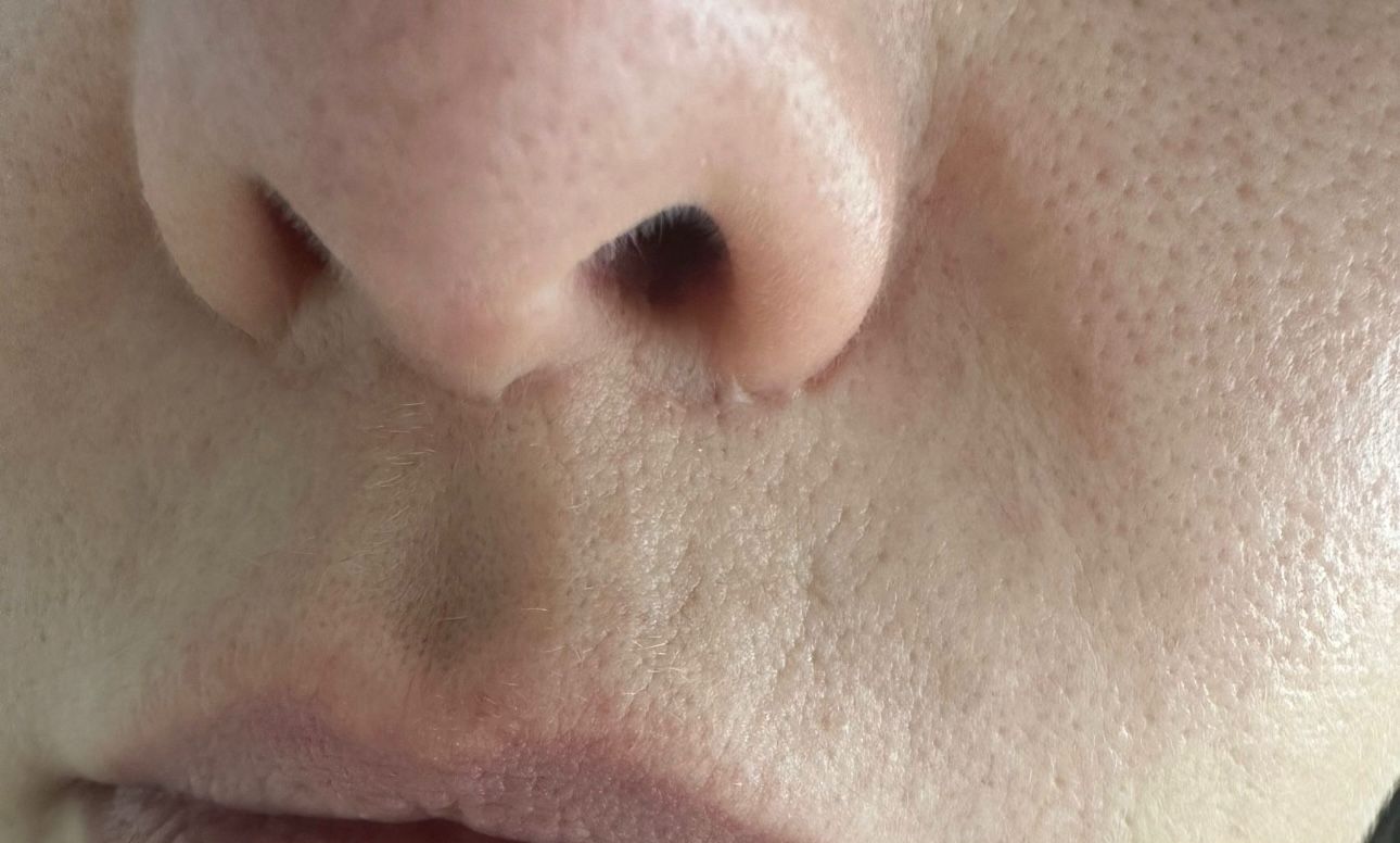 lip-lift-scaring.jpeg