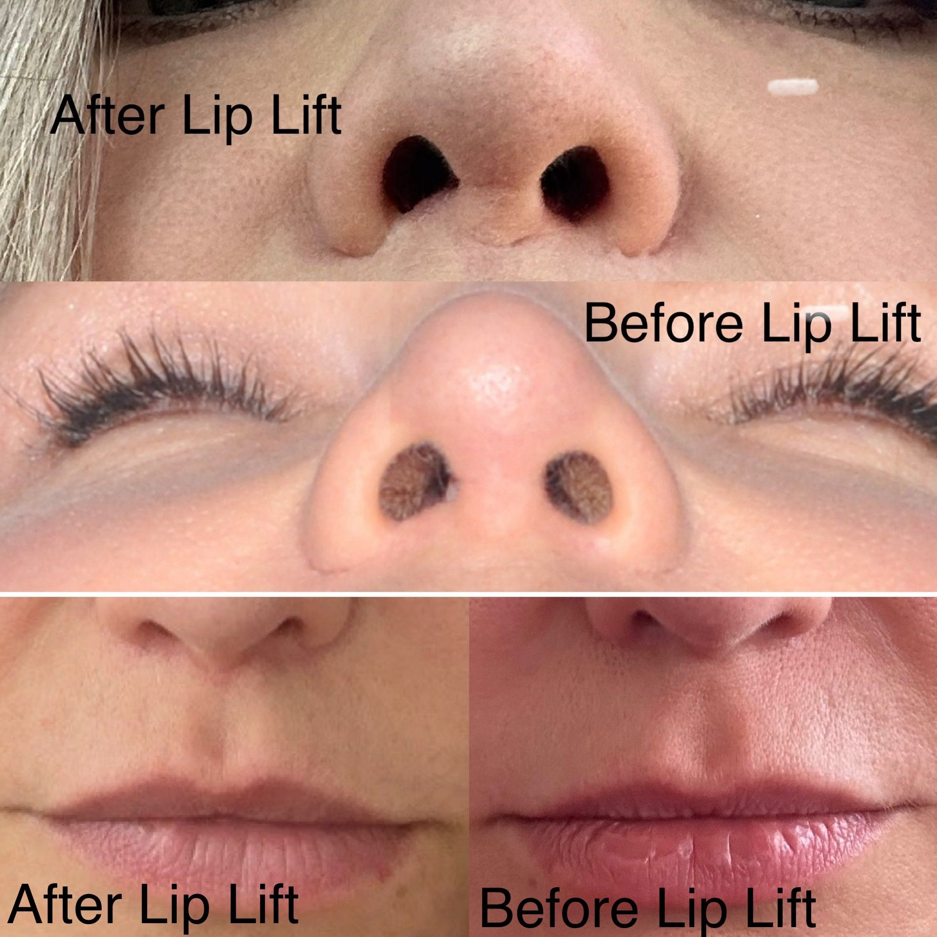 lip-lift-before-and-after.jpg
