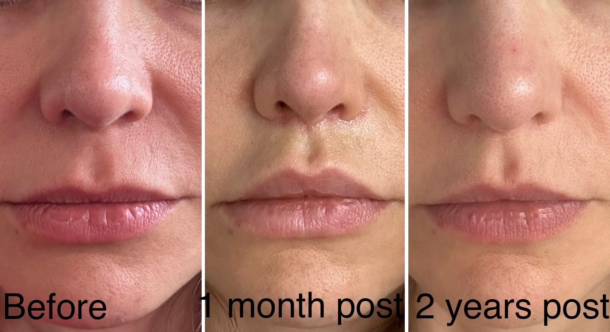 lip-lift-healing.jpeg