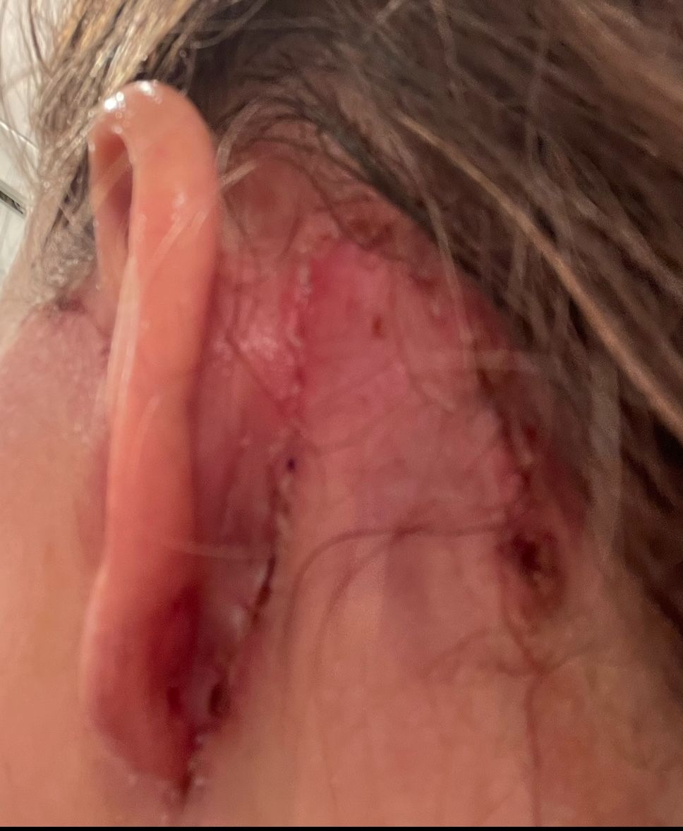 3 weeks post surgery