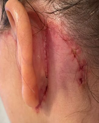 4 weeks post op